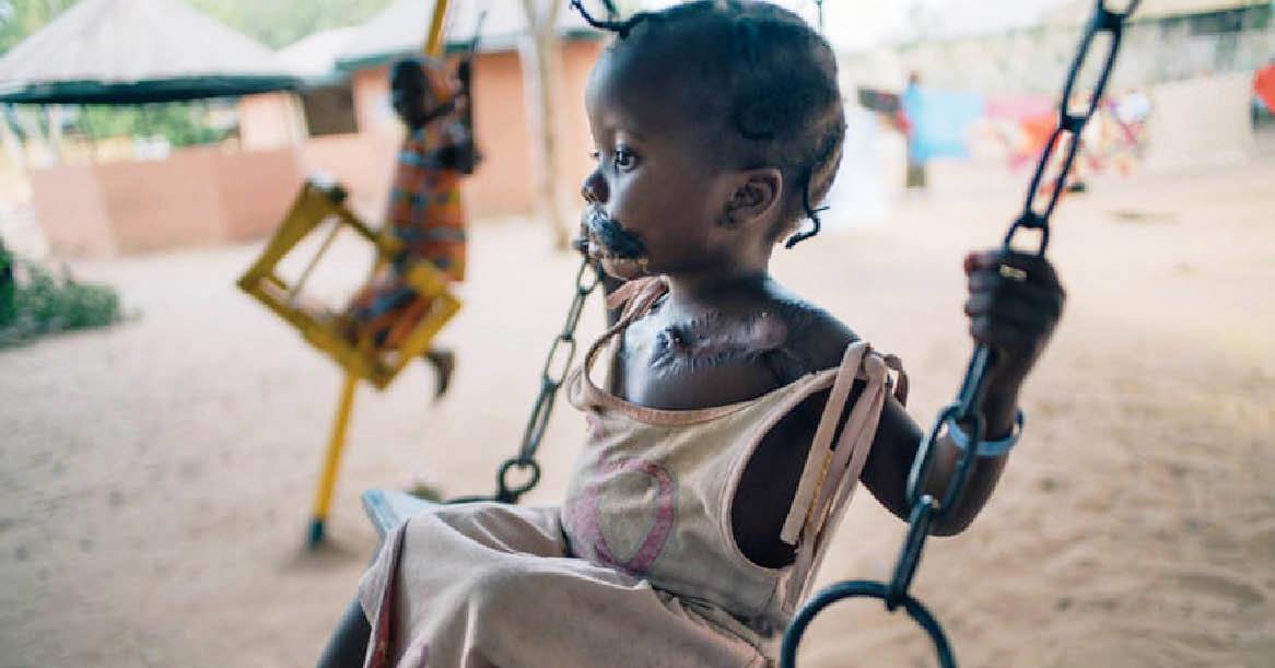 WHO bổ sung bệnh viêm họng hoại tử vào danh sách các bệnh nhiệt đới bị lãng quên