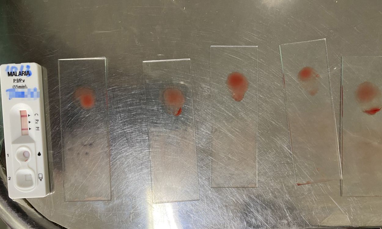 Phát hiện ca bệnh sốt rét ngoại lai trở về từ Angola