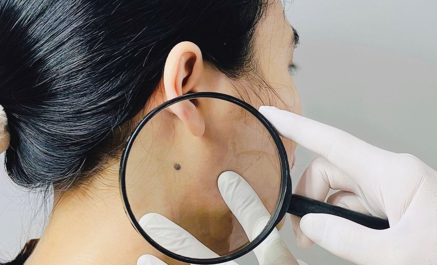 Bệnh viện Trung ương Huế tầm soát ung thư da miễn phí cho 50 bệnh nhân