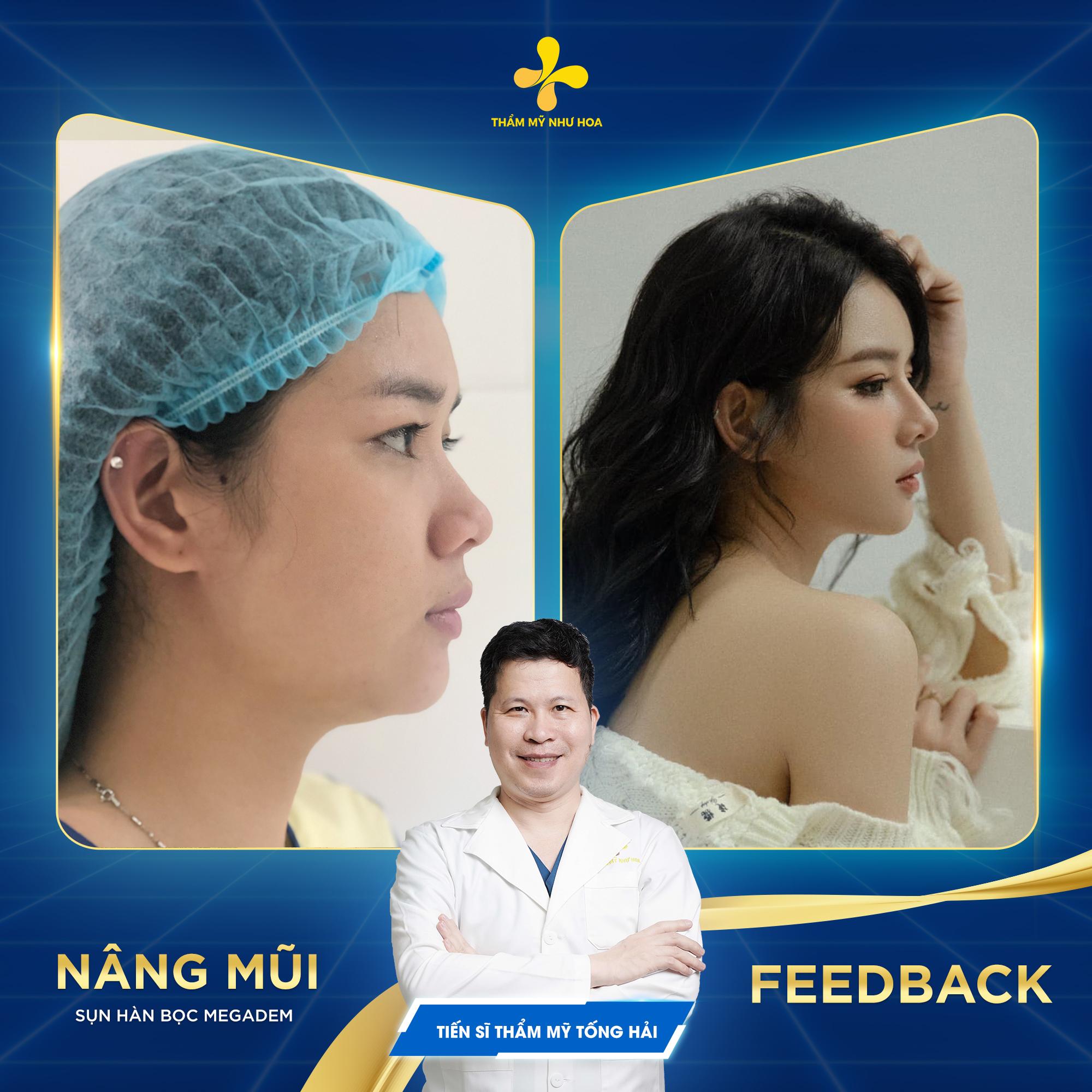 Địa chỉ nâng mũi uy tín được nhiều chị em lựa chọn