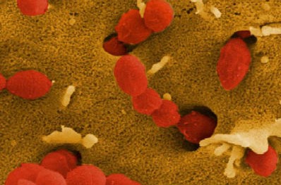 Ghi nhận một ca bệnh liên cầu lợn