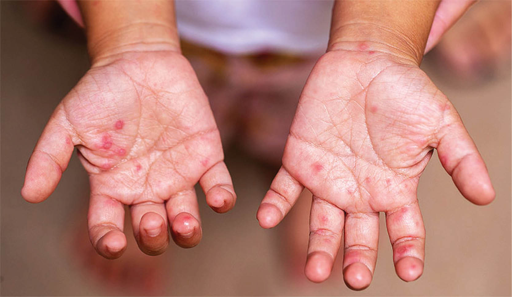 Các đợt bùng phát bệnh tay chân miệng sẽ trở nên trầm trọng hơn do biến đổi khí hậu