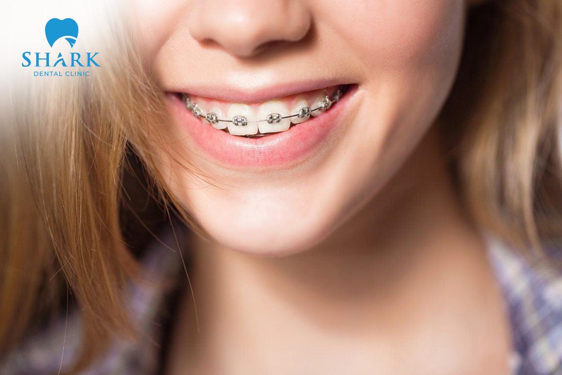 Niềng răng có hiệu quả không Khám phá địa chỉ niềng răng uy tín