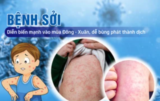 Thủ tướng Chính phủ chỉ đạo tăng cường công tác phòng, chống bệnh sởi