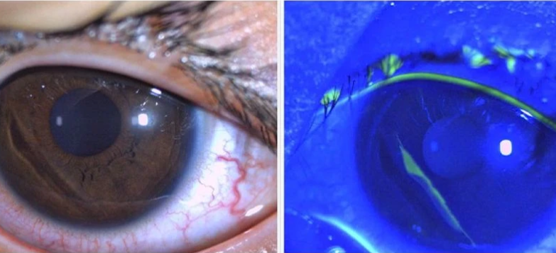 Chú ý bệnh lý ở mắt khi trẻ mắc cúm, sởi