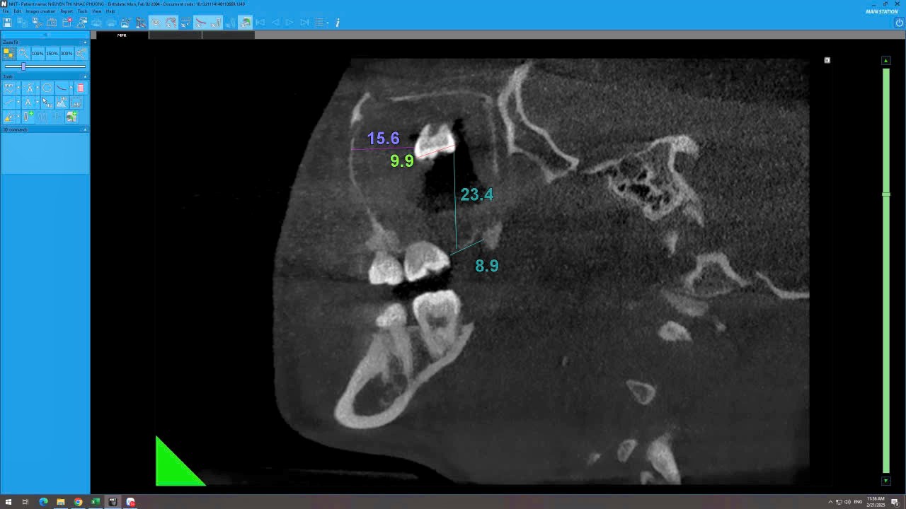 Phẫu thuật lấy răng ngầm lạc chỗ hiếm gặp cho một nữ bệnh nhân