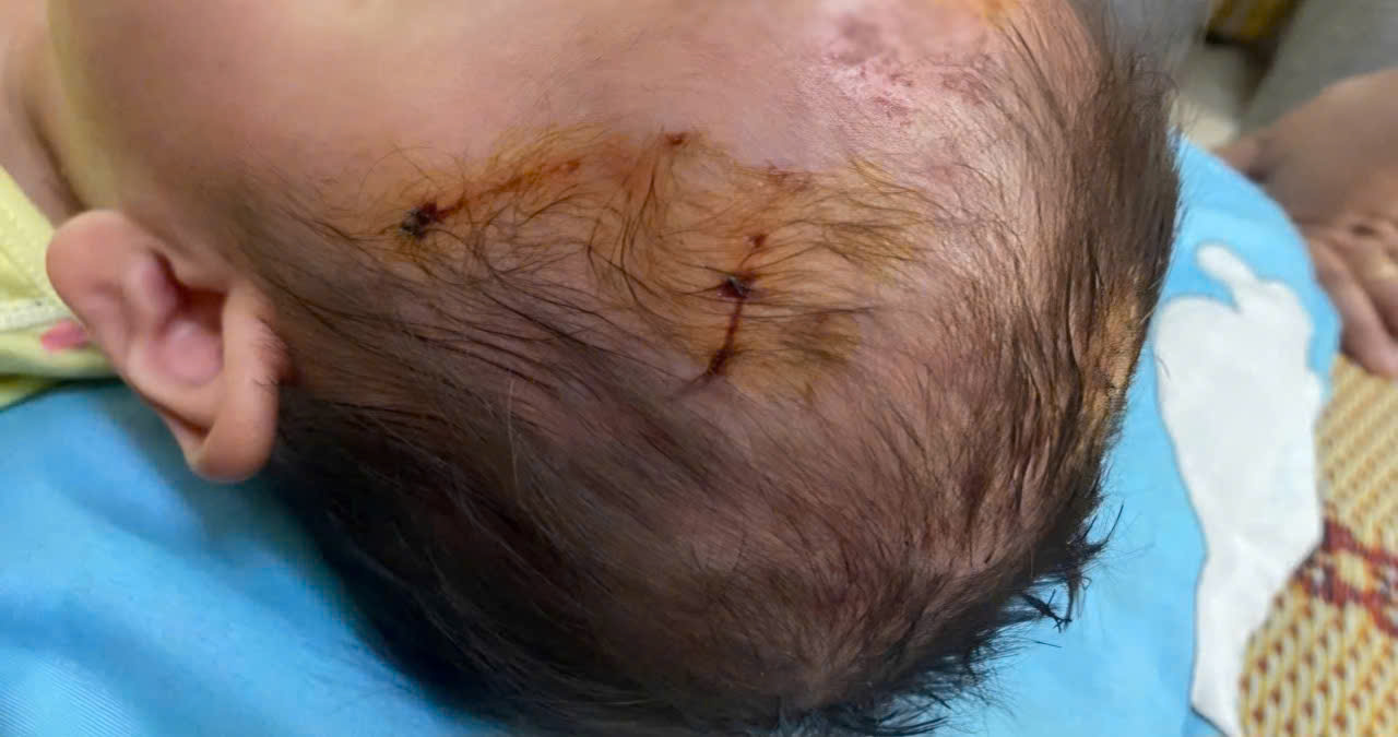 Trẻ 19 tháng tuổi bị chó dữ cắn nhiều vết ở vùng đầu, mặt, cổ