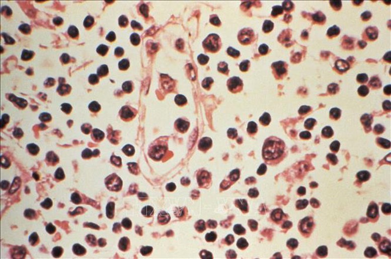 Virus Hanta Xác nhận 6 ca nhiễm, nguy cơ lây lan toàn cầu ở mức thấp