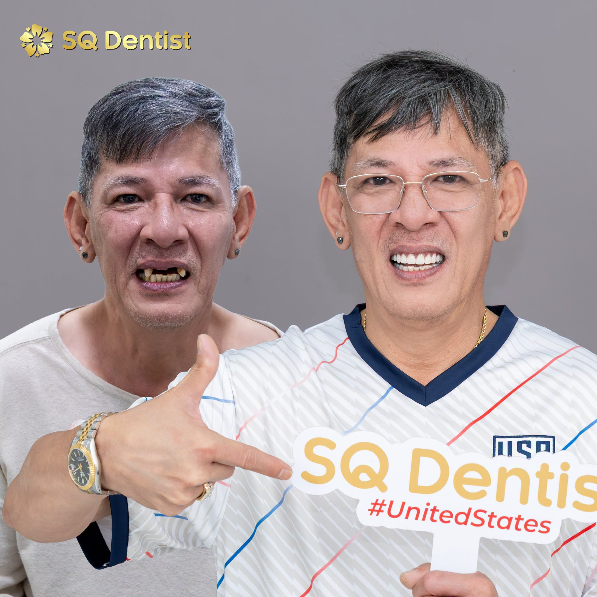 Implant tức thì là gì Có thể nhổ răng và cấy trụ trong cùng một ngày không
