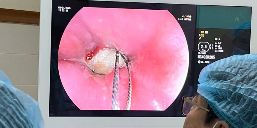 Removal of sharp bone causing breathing difficulties for a young man