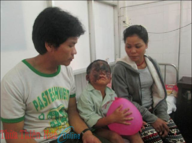 Em bé 7 tuổi bỏng hết khuôn mặt