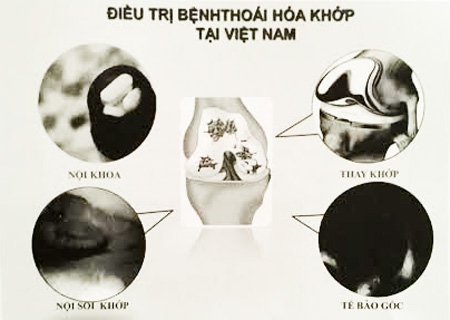 Nhiều bất cập trong điều trị thoái hoá khớp giai đoạn đầu