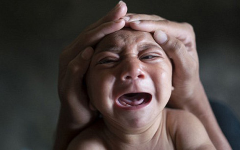 Trẻ sơ sinh bị chứng đầu nhỏ liên quan đến Zika đã tử vong ở Panama