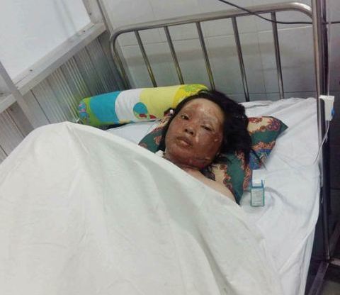 Hai sinh viên bỏng nặng cần giúp đỡ