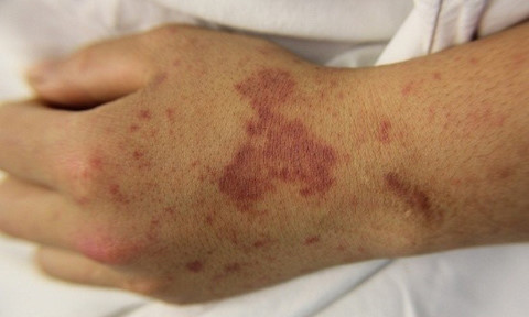 Sai lầm cần tránh khi trẻ bị viêm màng não mô cầu