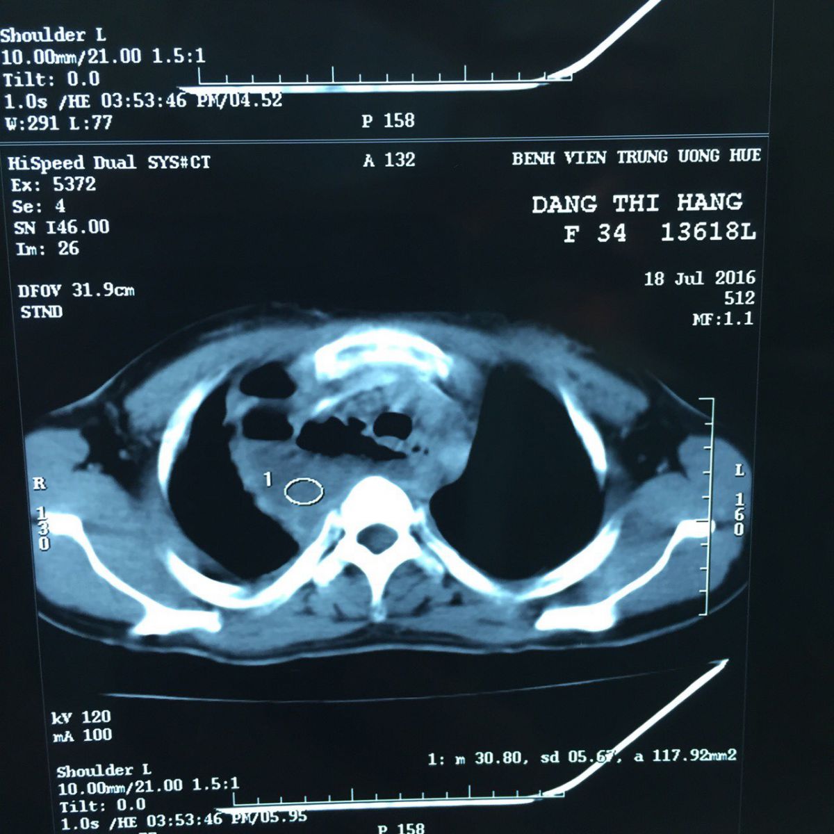 Cứu sống bệnh nhân bị áp xe trung thất do thủng thực quản