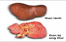 Dấu hiệu nhận biết bệnh ung thư gan