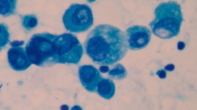 Xác định thêm 7 tác nhân ung thư ở người