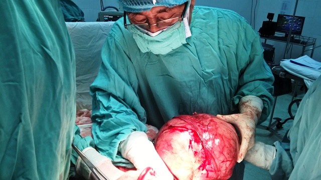 Phẫu thuật thành công cho bệnh nhân có khối u xơ tử cung hơn 5kg