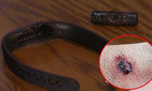 Vòng đeo tay thông minh Fitbit phát nổ gây bỏng