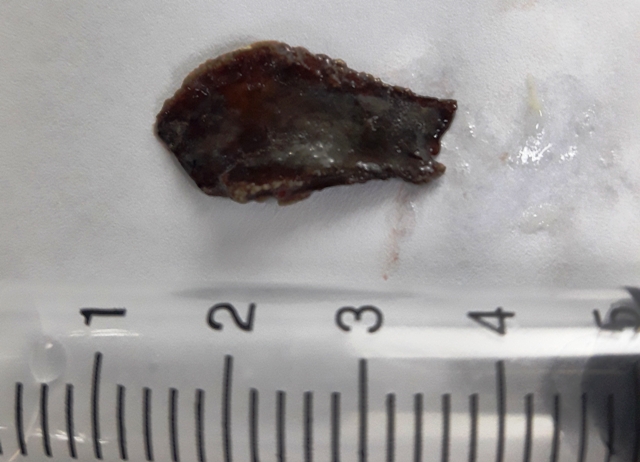 Gắp dị vật 2,5cm nằm quên 4 năm trong phế quản