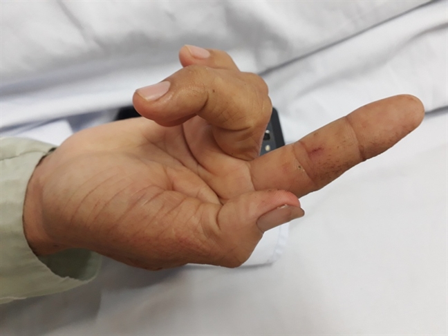 Cứu sống người đàn ông 53 tuổi bị rắn hổ cắn