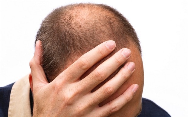 Hói đầu sớm - nguy cơ tim mạch ở nam giới