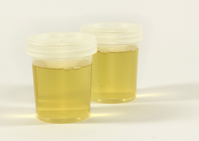 Nhật Bản triển khai mô hình xét nghiệm nước tiểu phát hiện ung thư