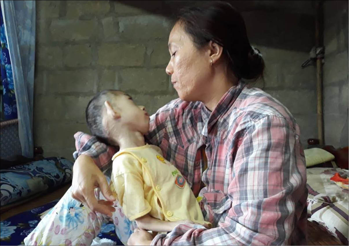 Bé bại não 10 tuổi nặng chưa tới 6kg