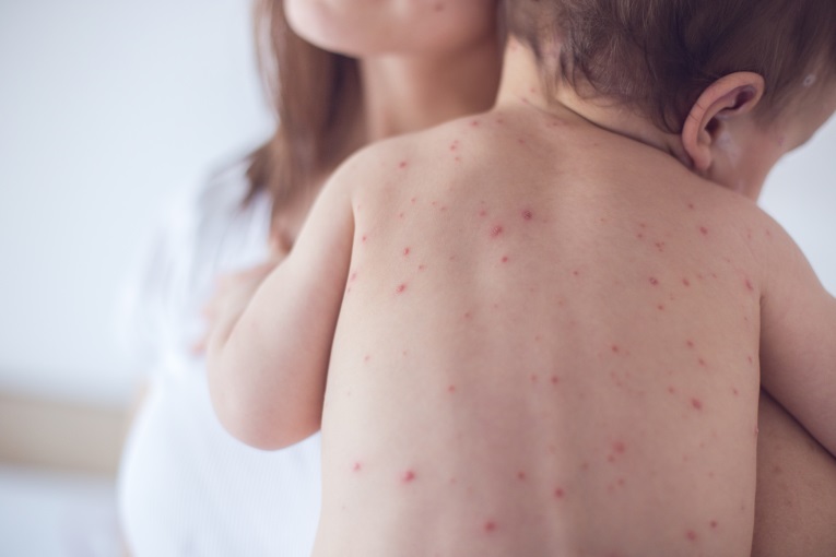 Nhật Bản Bùng phát đại dịch Rubella