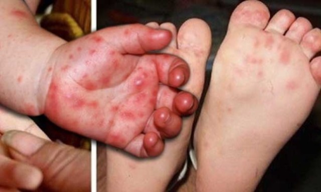 Ưu tiên cung ứng đủ thuốc phòng, chống bệnh tay chân miệng