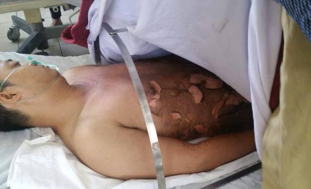 Một thanh niên bỏng nặng khi đang đổ xăng