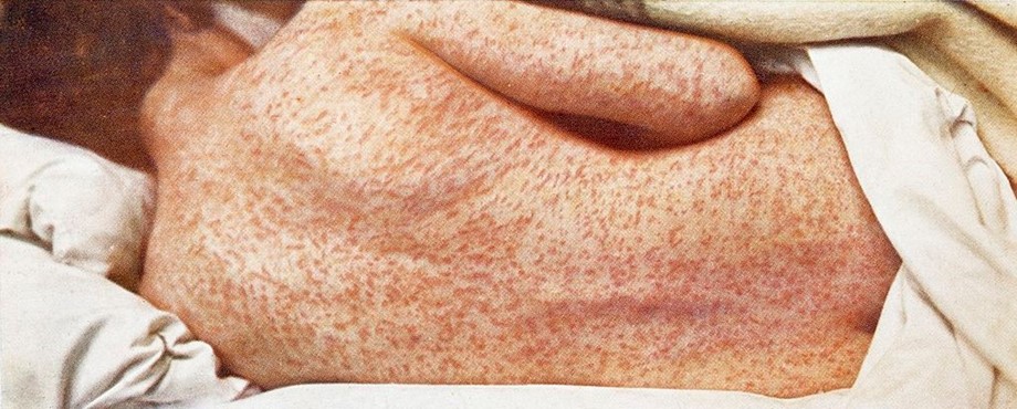 New York Quận Rockland tuyên bố tình trạng khẩn cấp về bệnh sởi