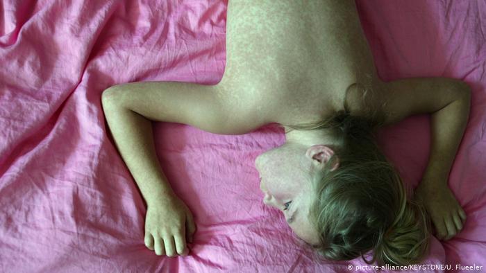 WHO Hơn 35 000 trường hợp mắc bệnh sởi ở châu Âu trong vòng 2 tháng đầu năm