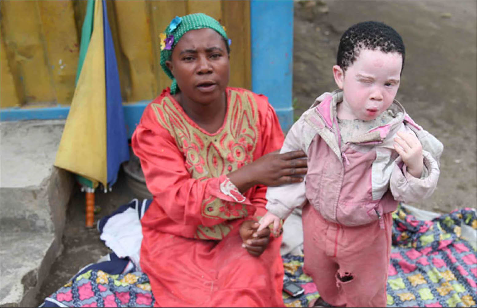 Thế giới kỷ niệm Ngày Quốc tế nhận thức về bệnh bạch tạng