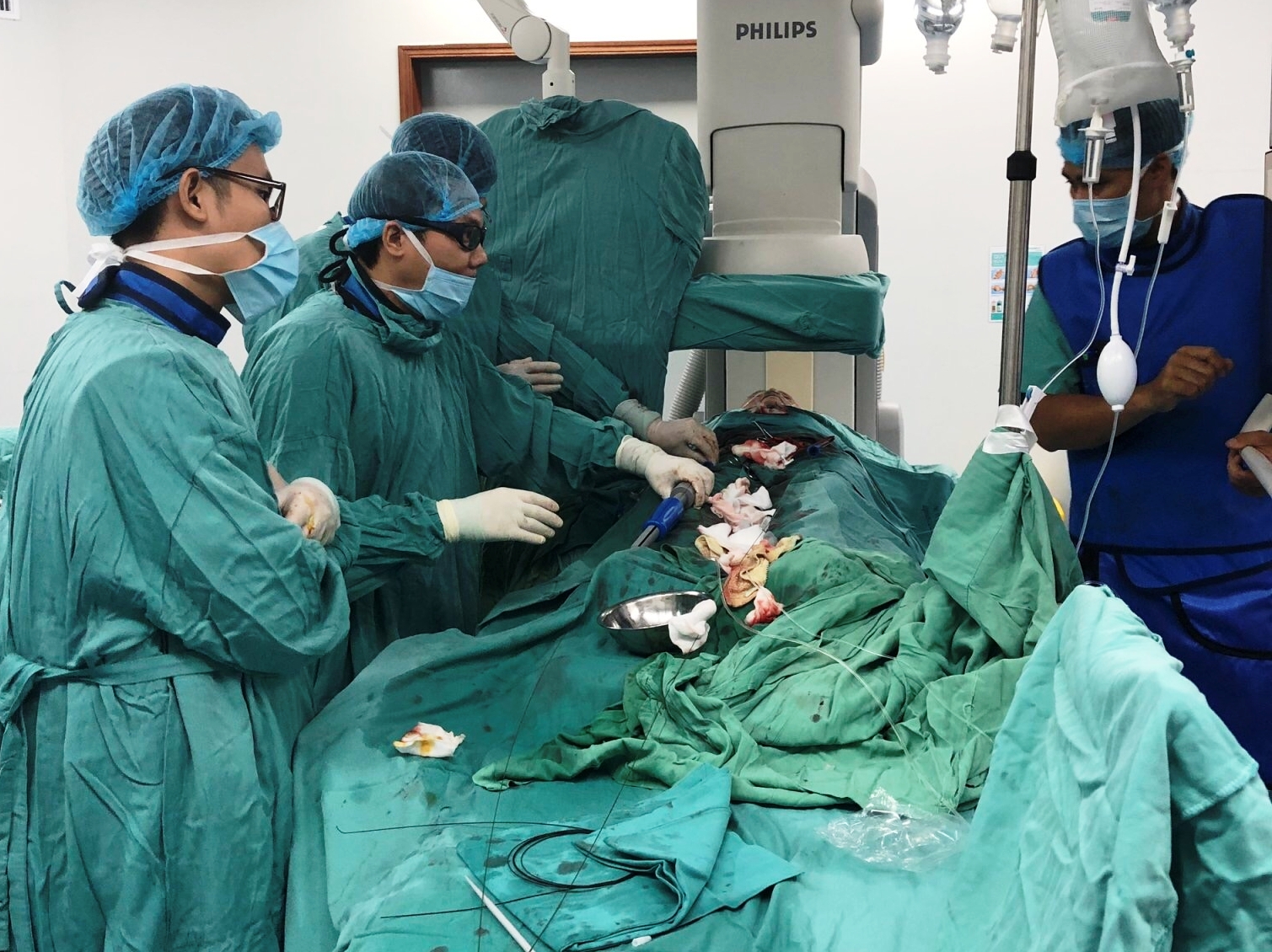 Cứu sống bệnh nhân phình động mạch chủ bụng lớn và hẹp hai nhánh động vành