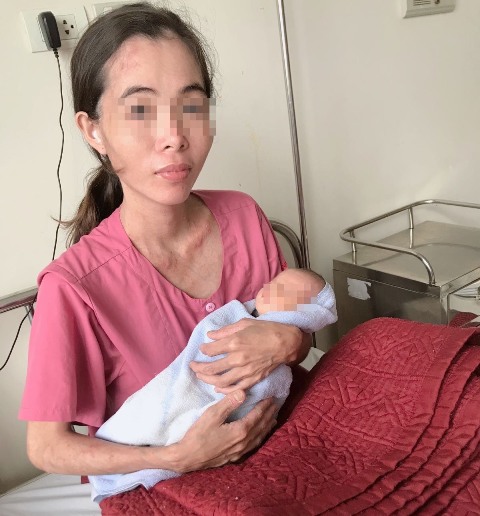 Cứu sống thai nhi có dây rốn thắt nút hiếm gặp