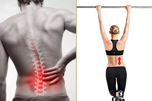 Thoát vị đĩa đệm có nên tập xà đơn không