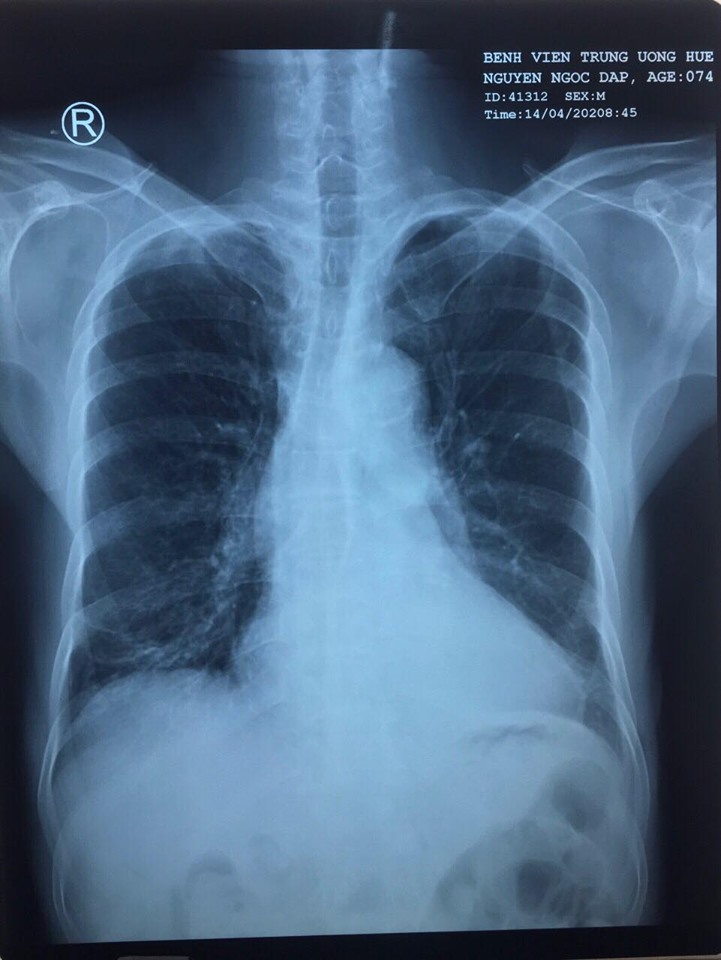 Lấy mảnh xương cá bỏ quên trong phế quản sau 5 năm