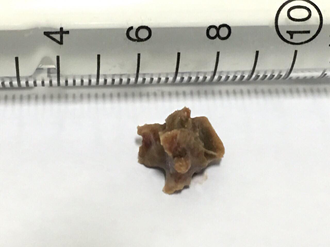 Removing a 5-year forgotten fish bone in the bronchial