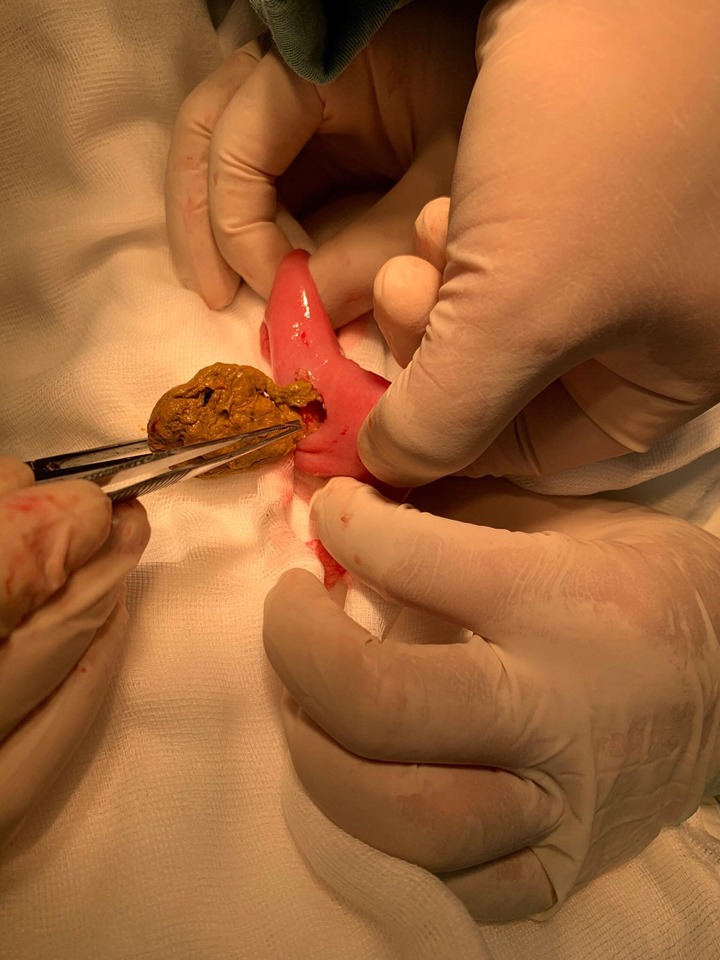 Cấp cứu bệnh nhân bị lồng ruột do mắc lưỡi câu và dây câu