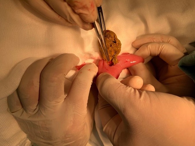 Resuscitation for patient with intussusception due to hook and fishing line