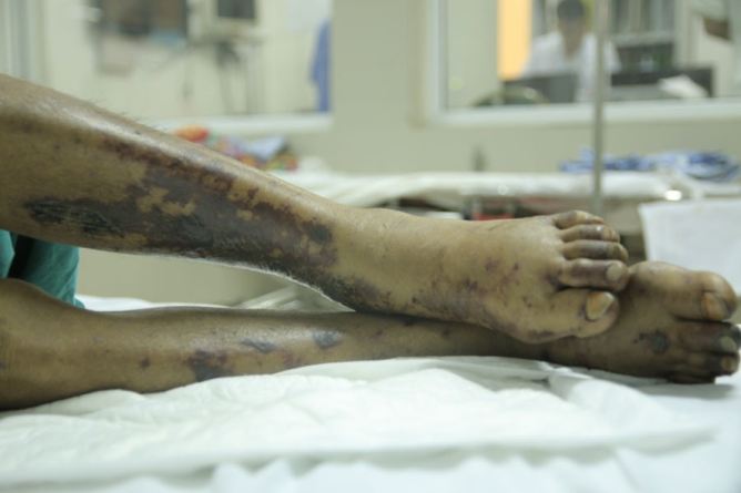 Phát hiện ca bệnh liên cầu lợn tại Hương Trà