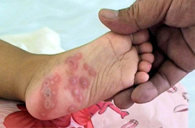 Vệ sinh sạch sẽ - lá chắn phòng bệnh tay chân miệng