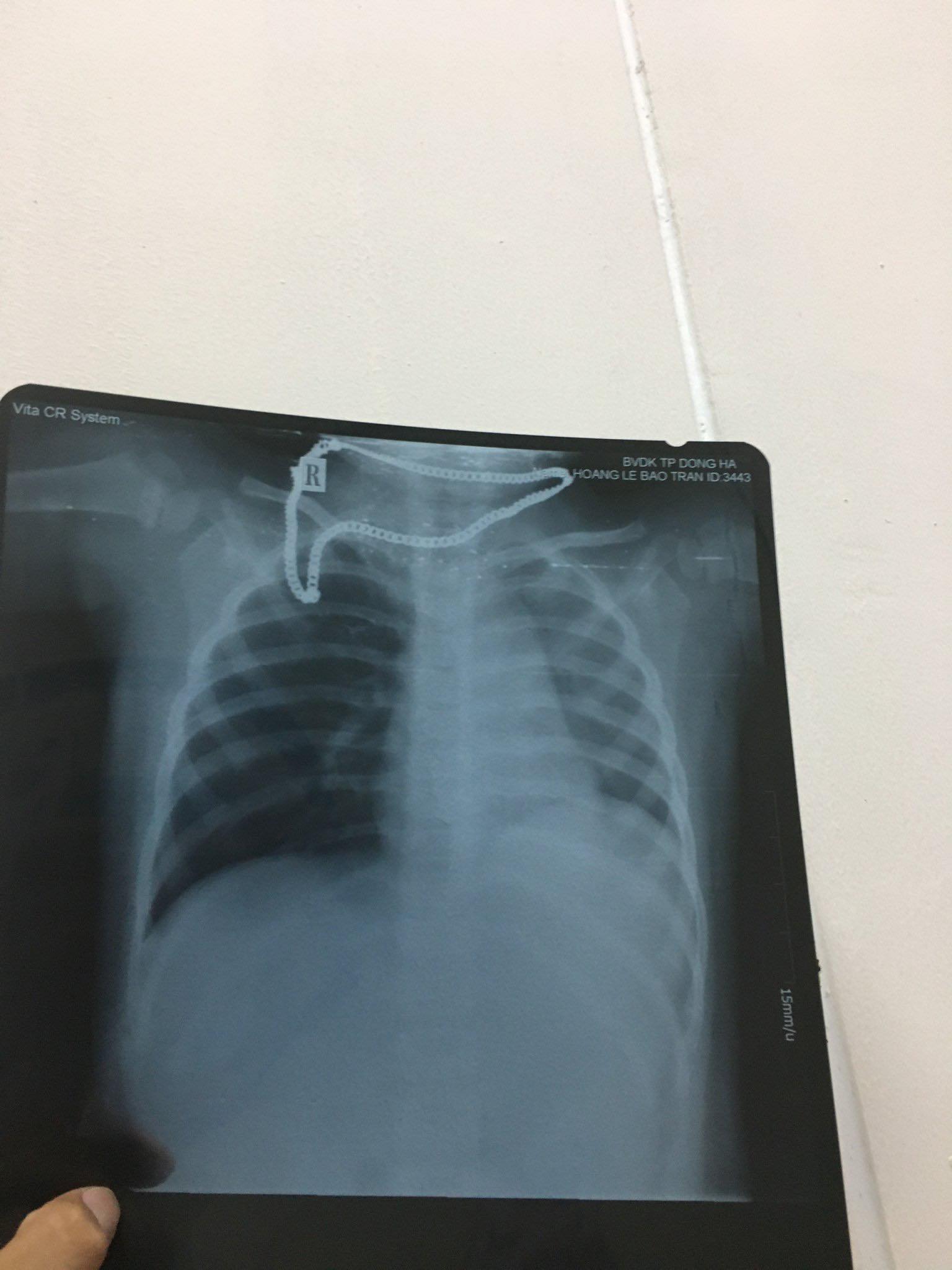 Cảnh báo dị vật đường thở gây tắc phổi ở trẻ nhi