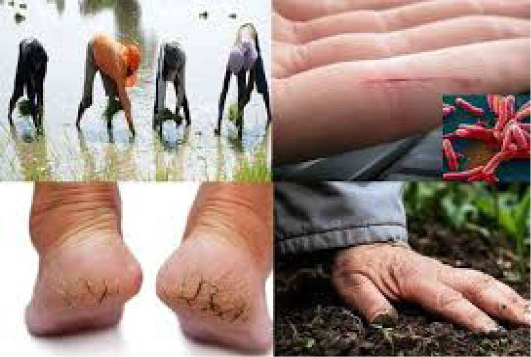 Mùa lụt, cẩn trọng với bệnh lây nhiễm cơ hội Whitmore