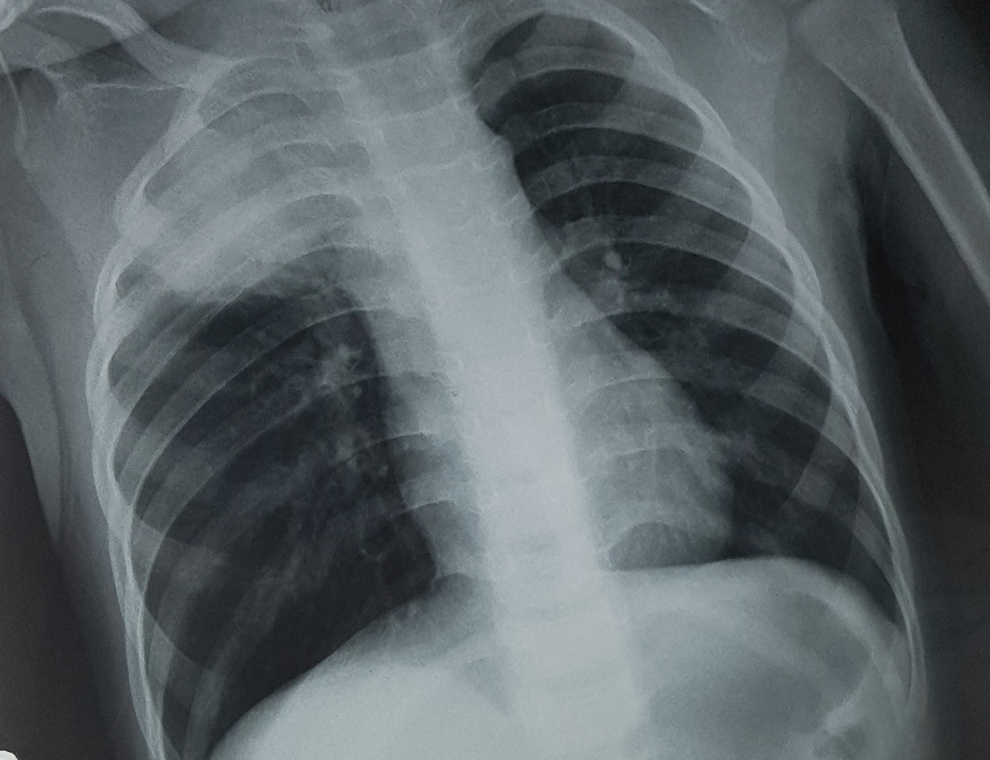 Cứu sống bé trai bị hóc hạt đậu phộng