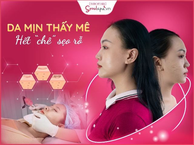 Trị sẹo rỗ hiệu quả chỉ sau một liệu trình tại Thẩm mỹ viện Seoul Spa