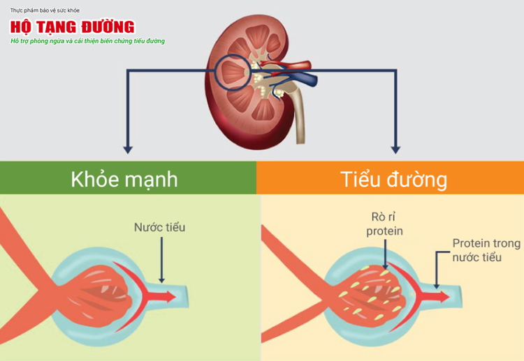 Bệnh thận tiểu đường - phát hiện càng sớm, cơ hội ngăn ngừa suy thận càng cao