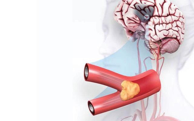 Phòng ngừa tai biến, bảo vệ sức khỏe tốt hơn